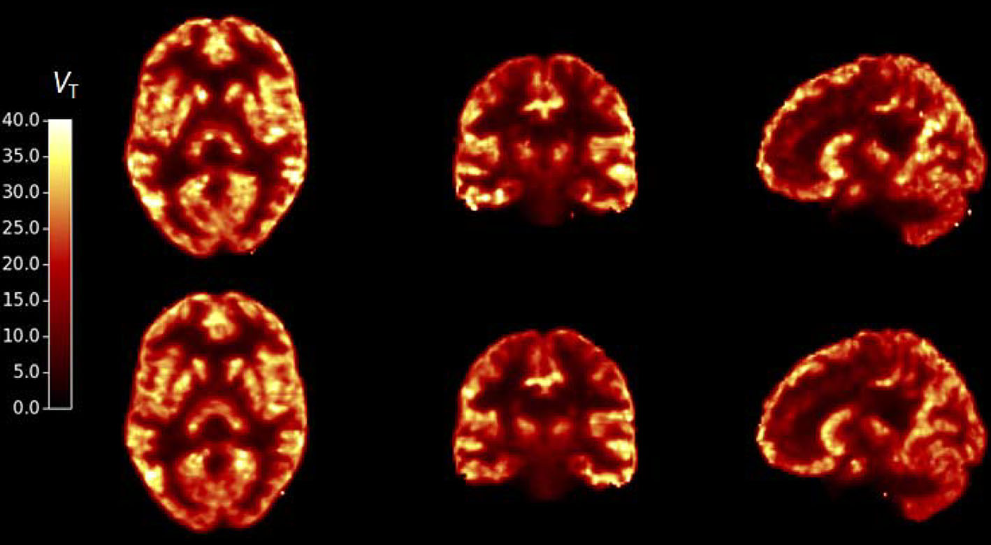 SV2A PET total uptake in a healthy human, axial, coronal and sagittal, two scans